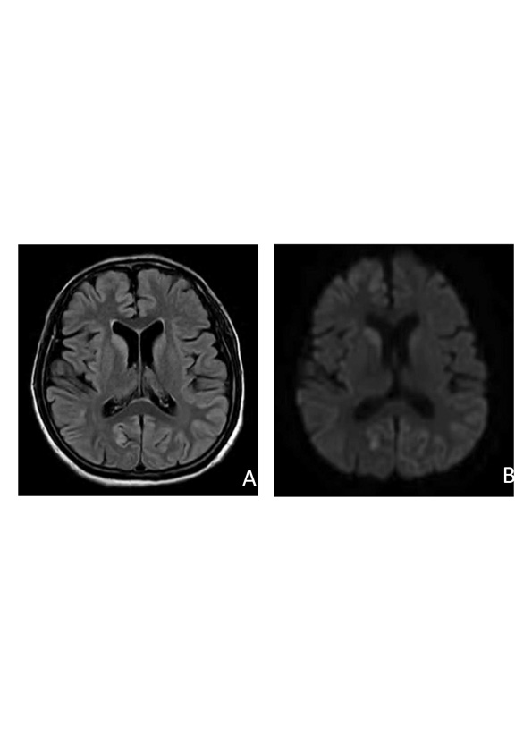 Creutzfeldt-Jakob Disease in Sanpasitthiprasong Public Referral Hospital in Ubon Ratchathani Northeast Thailand : A Case Series and Review of the Literature